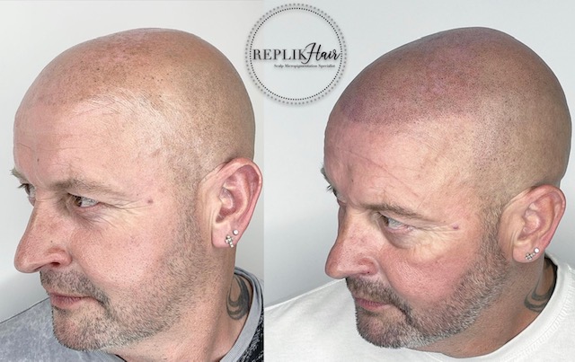 SMP Correction — Replik Hair - Scalp Micropigmentation Specialist - Bolton,  Greater Manchester